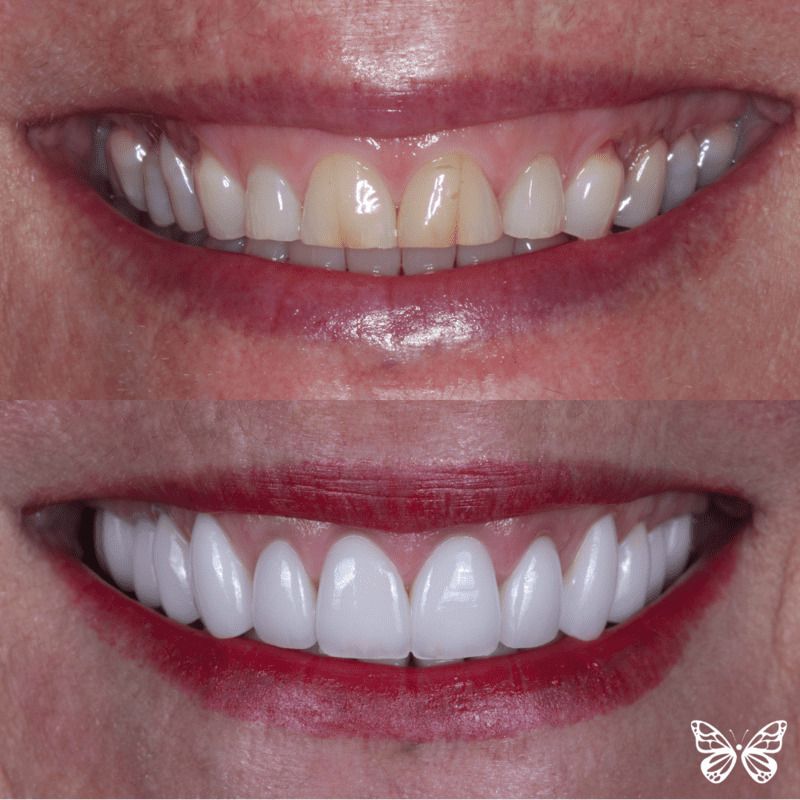 CA San Jose dental fillings procedure so young park dds