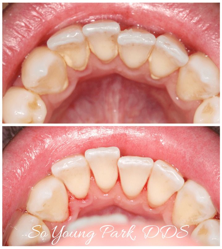 CA San Jose dental fillings procedure so young park dds