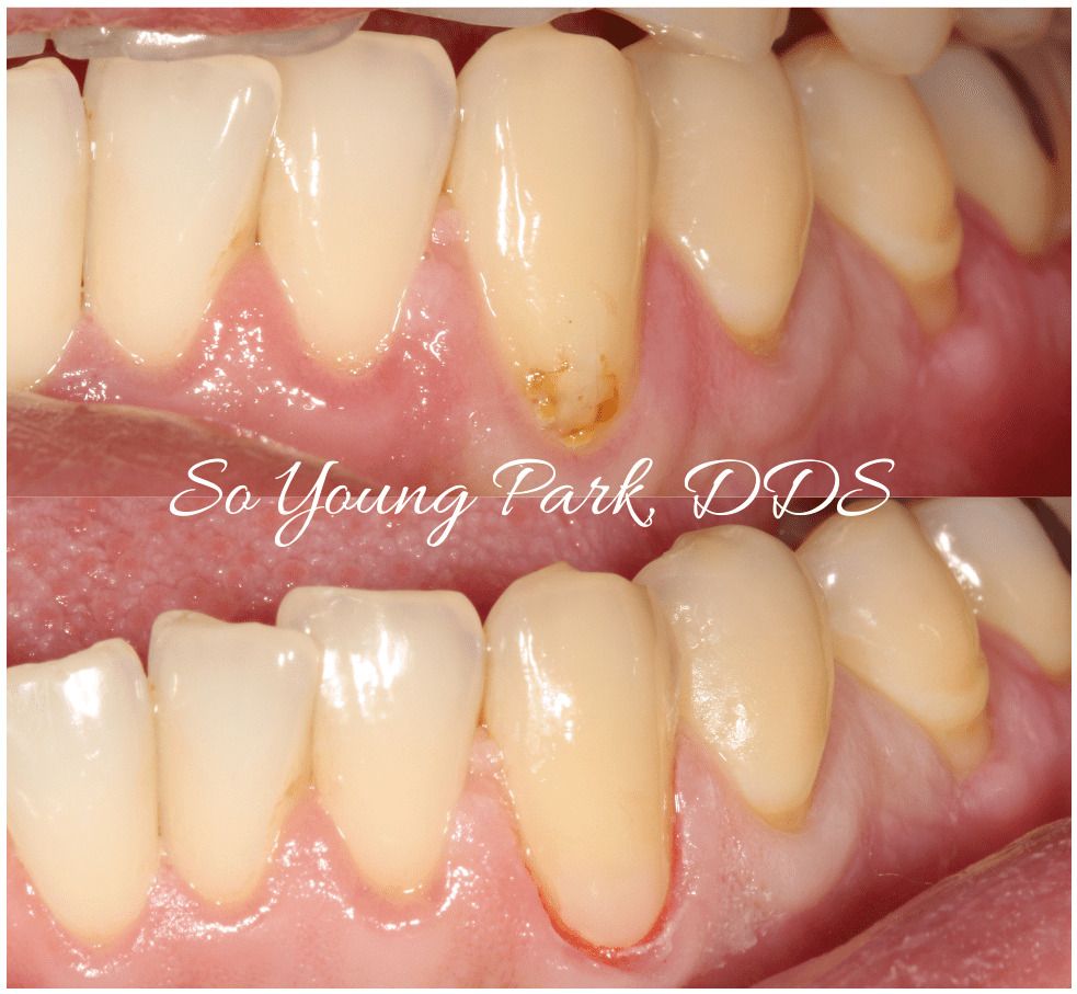 CA San Jose dental fillings procedure so young park dds