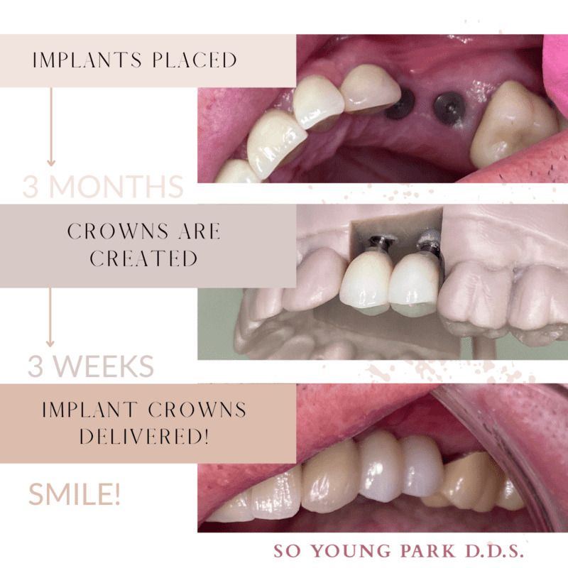 CA San Jose implant consultation so young park dds