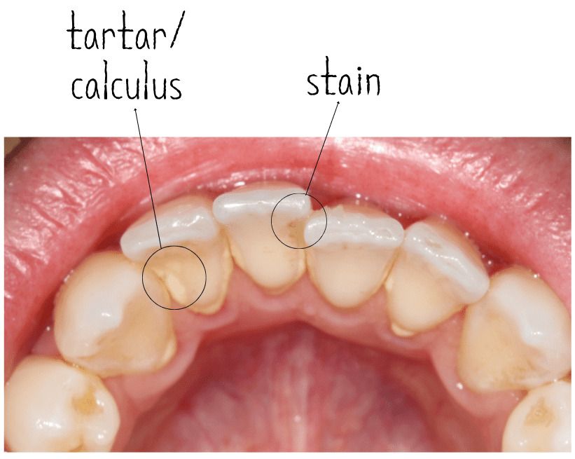 CA San Jose dental cleaning so young park dds
